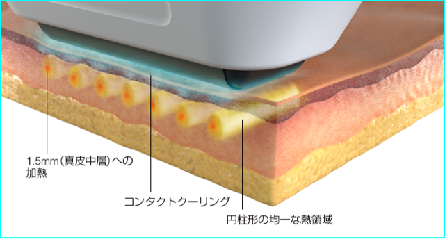 ソフウェーブ(Sofwave) の特徴