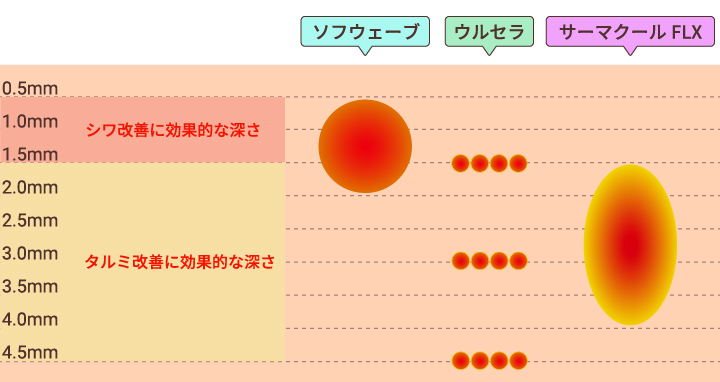 ウルセラ・サーマクールとの違い