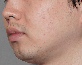 毛穴の開きbefore
