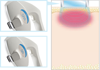 美肌治療の「SR」もしくはより強力な「SRA」光（IPL）と高周波（RF）