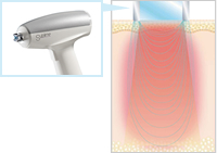 タルミ治療のサブライム赤外線 （IR）と高周波（RF)