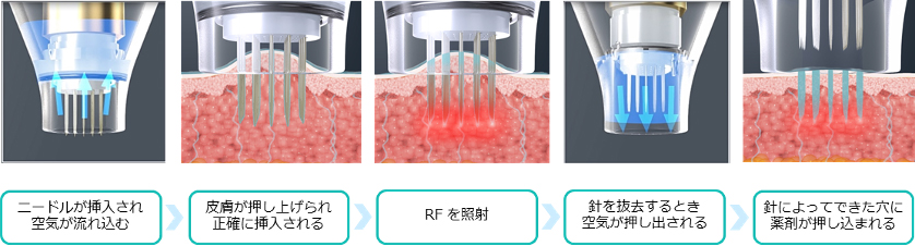 真皮層まで薬剤をしっかり届ける