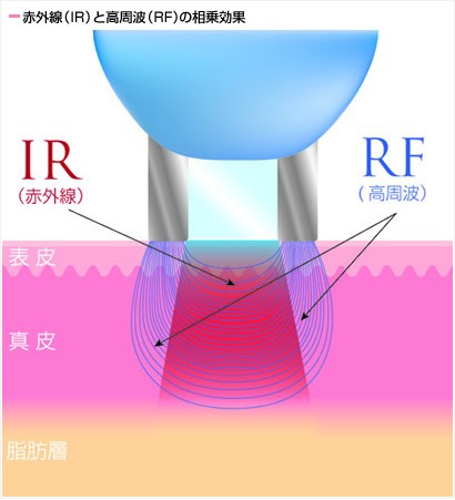 赤外線（IR）と高周波（RF）の相乗効果