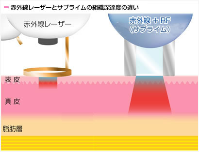 赤外線レーザーとサブライムの組織深達度の違い