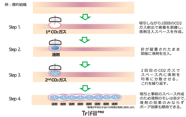 オートインジェクション(模式図)