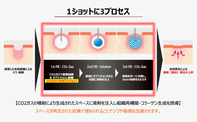 トライフィルプロの原理