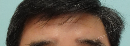 症例写真4after