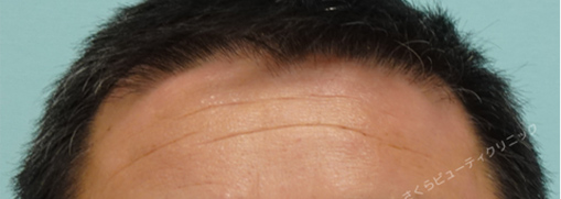 症例写真4before