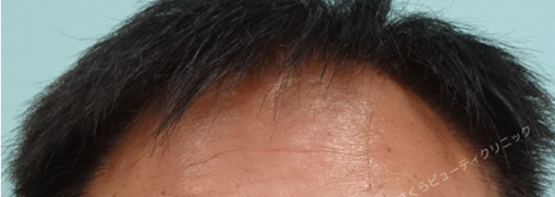 症例写真6after