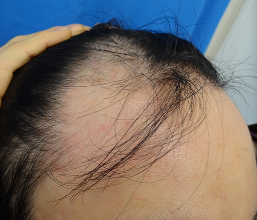 症例写真11before