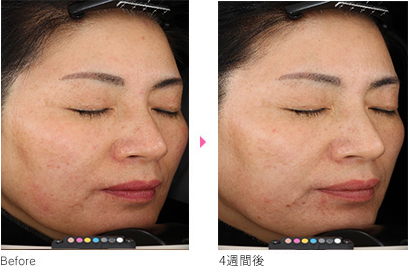 リジュラン 肌そのものを若返らせる 肌再生注射 北九州の美容外科 美容皮膚科 さくらビューティクリニック